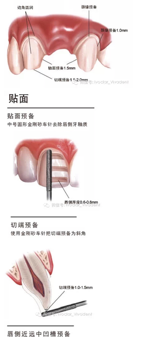 時常搞不清楚怎么備牙嗎？義獲嘉教您如何完美備牙