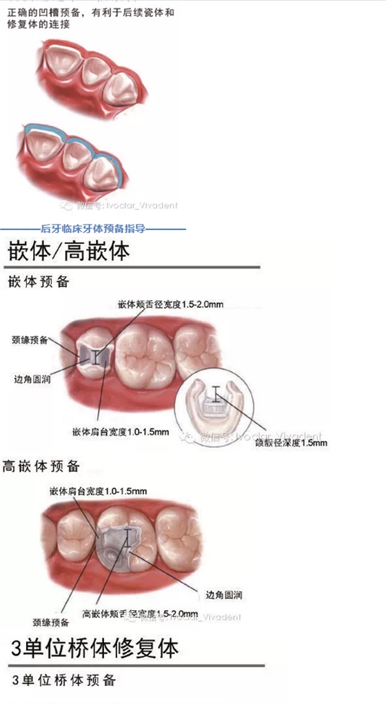 時常搞不清楚怎么備牙嗎？義獲嘉教您如何完美備牙