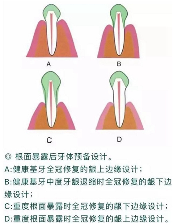 做全冠修復時基牙根面暴露，如何備牙？