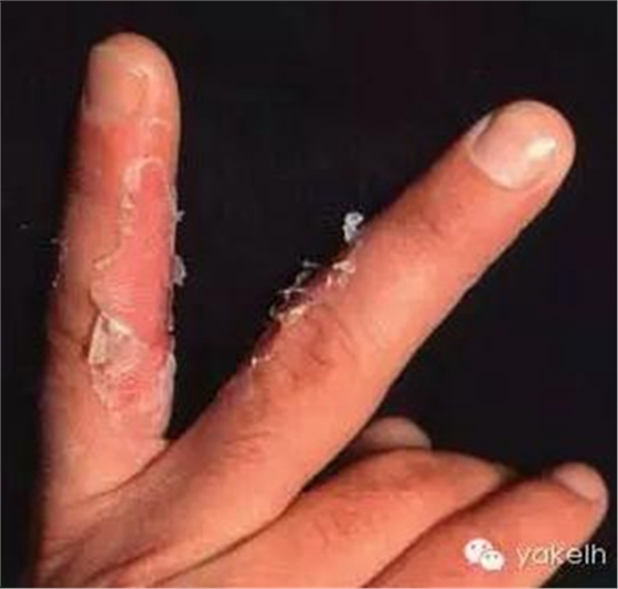 正畸中與材料相關(guān)的副作用---樹脂基材料的過敏反應