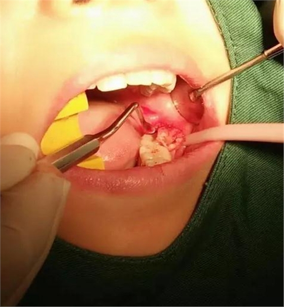 拔牙斷根的去與留？