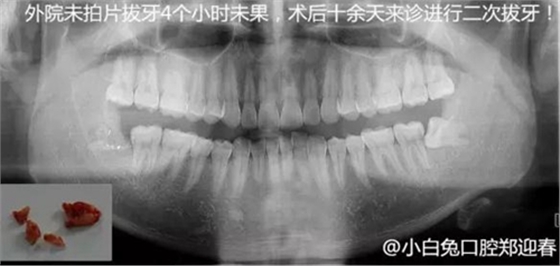 拔牙斷根的去與留？