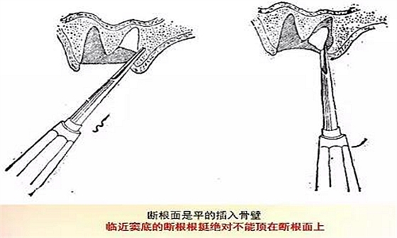 拔牙斷根的去與留？