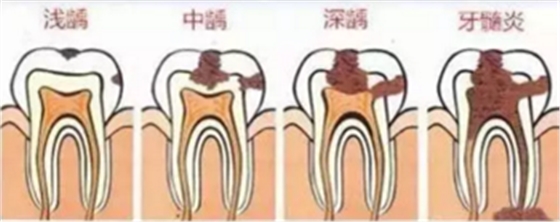 當心“腹黑”齲齒，牙齒有個小洞也要補！