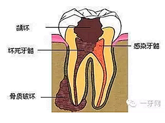 詳解牙疼的原因分幾種？