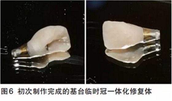 前牙即刻種植并個性化基臺美學(xué)修復(fù)