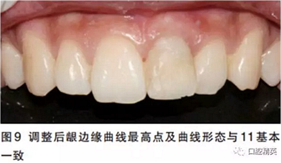 前牙即刻種植并個性化基臺美學(xué)修復(fù)