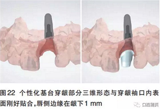 前牙即刻種植并個性化基臺美學(xué)修復(fù)