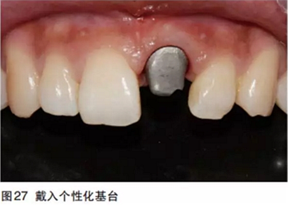 前牙即刻種植并個性化基臺美學(xué)修復(fù)