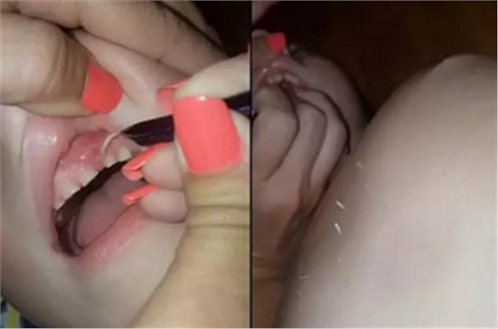 牙齦里拔出27片斷甲，是一種怎樣的體驗？