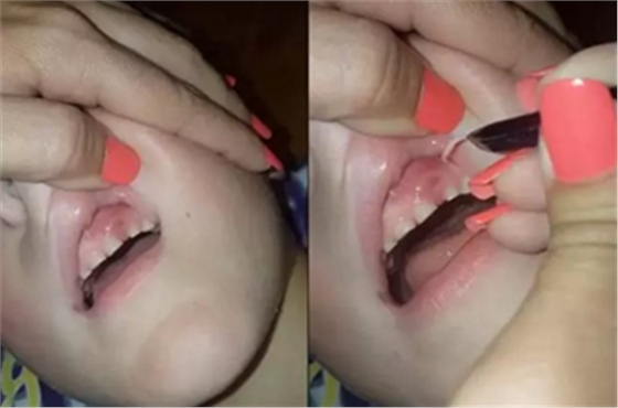 牙齦里拔出27片斷甲，是一種怎樣的體驗？