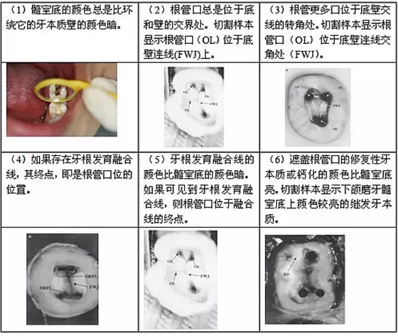 知識分享：根管治療的標(biāo)準(zhǔn)步驟