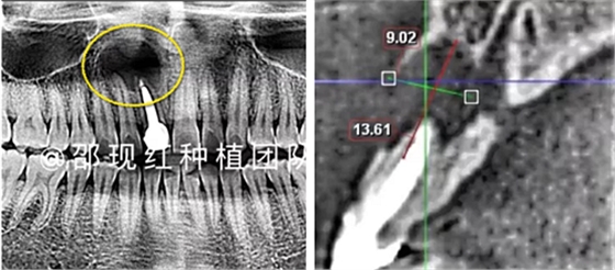 「科普篇」你真的了解它嗎？——β-磷酸三鈣