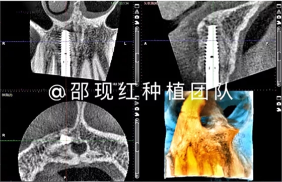 「科普篇」你真的了解它嗎？——β-磷酸三鈣
