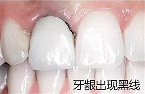 	烤瓷牙出現(xiàn)問題【不要猶豫】盡快去醫(yī)院拆除！