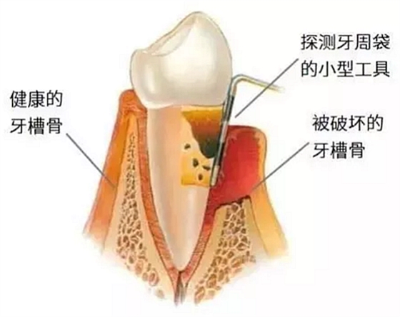 上海嘉?？谇谎芯克皇兰o牙周病的臨床進展