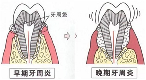 上海嘉?？谇谎芯克皇兰o牙周病的臨床進展