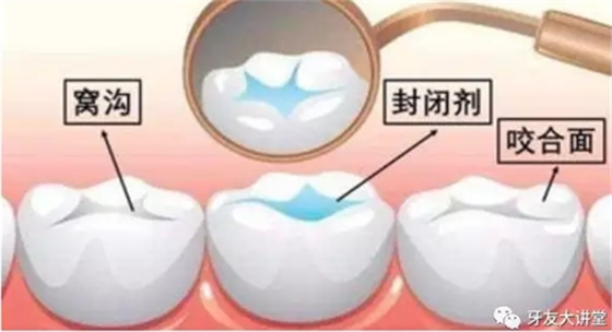 兒童防齲齒【窩溝封閉】和【涂氟】是一回事兒嗎？