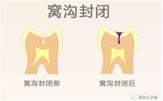 兒童防齲齒【窩溝封閉】和【涂氟】是一回事兒嗎？