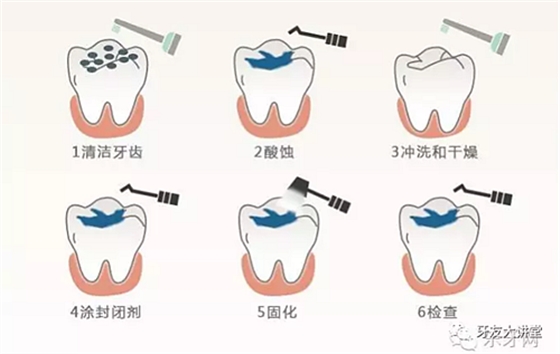 兒童防齲齒【窩溝封閉】和【涂氟】是一回事兒嗎？