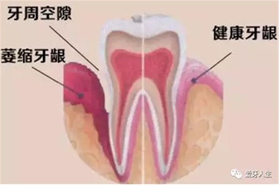 牙齦萎縮怎么辦？