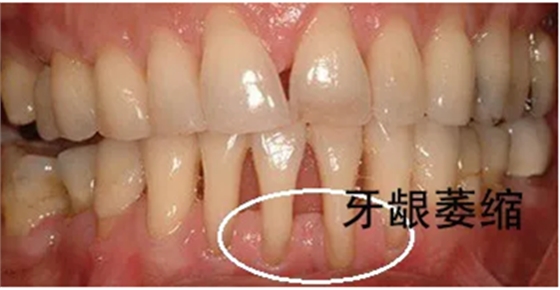 牙齦萎縮怎么辦？