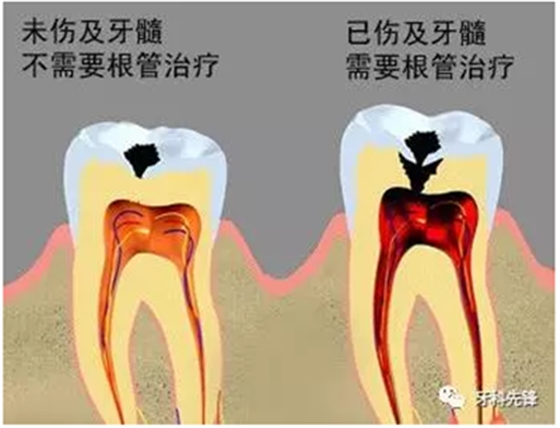 補(bǔ)牙不做冠，療效少一半！根管治療后牙齒已經(jīng)不疼了，為什么還要戴牙冠呢？
