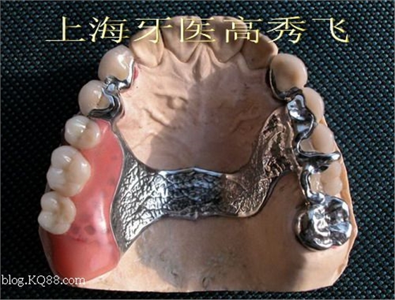 圖解后牙精密附著體修復2例（原創(chuàng)）