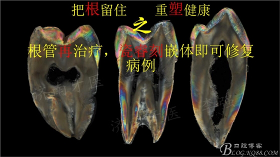 根管再治療，高嵌體即可修復（濟南牙醫(yī)~ 李強）