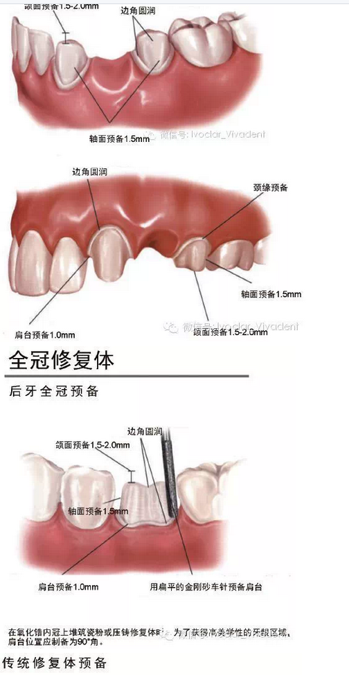 時(shí)常搞不清楚怎么備牙嗎？義獲嘉教您如何完美備牙