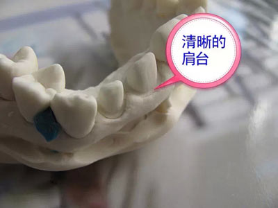 備牙應(yīng)注意的事項(xiàng)+備牙取摸損傷牙齦問(wèn)題