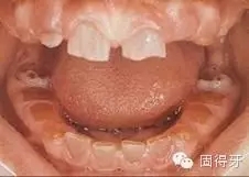 只知道蟲牙?快來看看那些你見都沒見過的牙病! 只知道蟲牙?快來看看那些你見都沒見過的牙?。?