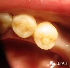只知道蟲牙?快來看看那些你見都沒見過的牙?。? 只知道蟲牙?快來看看那些你見都沒見過的牙病!