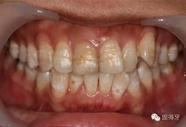 只知道蟲牙?快來看看那些你見都沒見過的牙??! 只知道蟲牙?快來看看那些你見都沒見過的牙??!