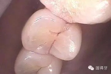 只知道蟲牙?快來看看那些你見都沒見過的牙病! 只知道蟲牙?快來看看那些你見都沒見過的牙??!