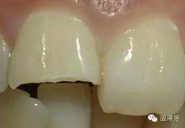 只知道蟲牙?快來看看那些你見都沒見過的牙?。? 只知道蟲牙?快來看看那些你見都沒見過的牙病!