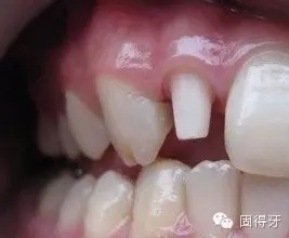 只知道蟲牙?快來看看那些你見都沒見過的牙??! 只知道蟲牙?快來看看那些你見都沒見過的牙??!