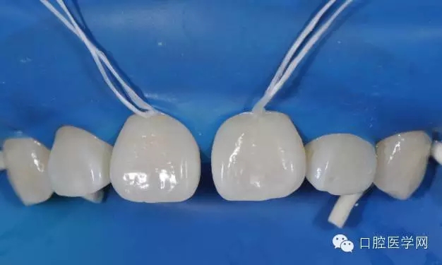 樹脂關(guān)閉前牙間隙