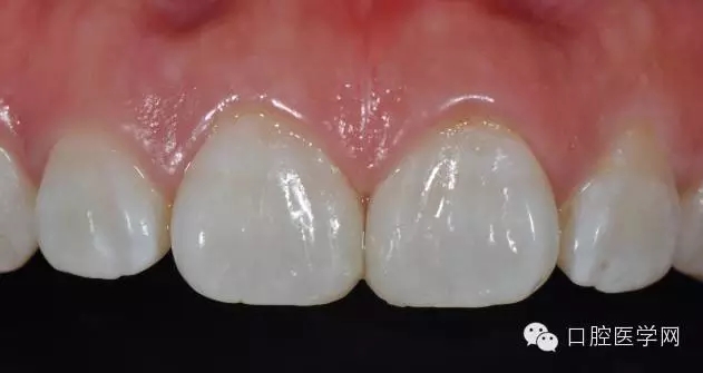 6樹脂關(guān)閉前牙間隙