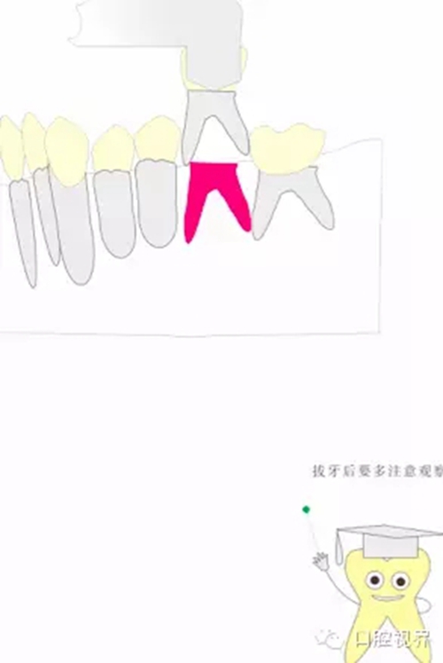 【愛牙科普知識300問】 “什么是活髓切斷術？”