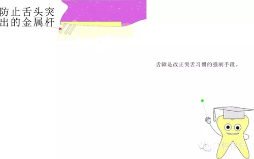 【愛(ài)牙科普知識(shí)300問(wèn)】 “什么是牙間牽引？”