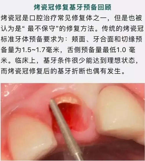 做全冠修復(fù)時(shí)基牙根面暴露，如何備牙？