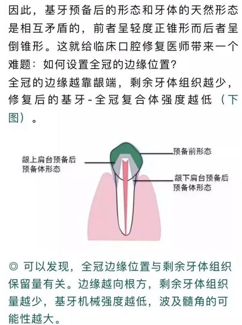 做全冠修復(fù)時(shí)基牙根面暴露，如何備牙？