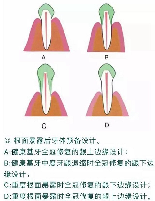 做全冠修復(fù)時(shí)基牙根面暴露，如何備牙？