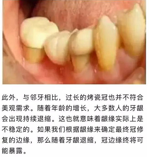 做全冠修復(fù)時(shí)基牙根面暴露，如何備牙？