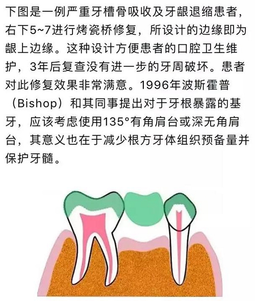 做全冠修復(fù)時(shí)基牙根面暴露，如何備牙？