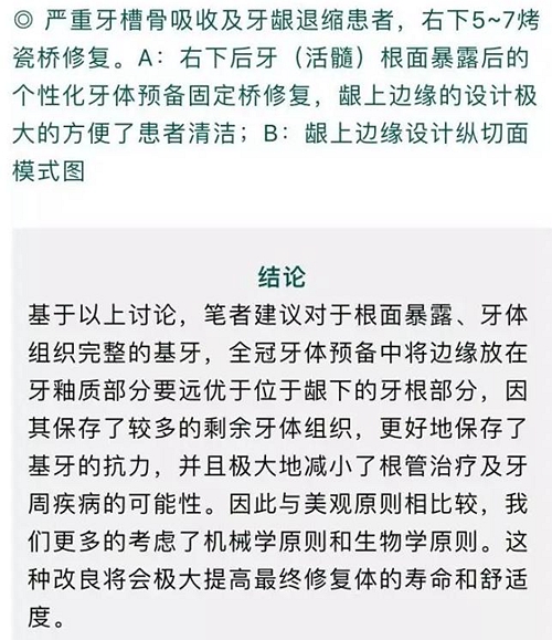 做全冠修復(fù)時(shí)基牙根面暴露，如何備牙？