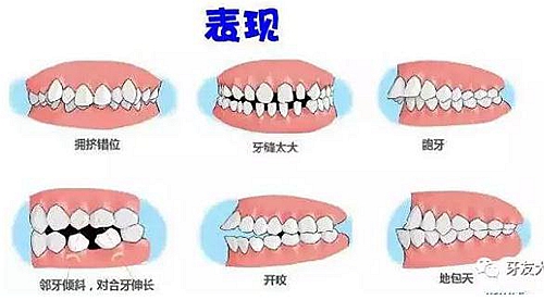 “發(fā)現即矯正”12歲前必須處理的20種兒童牙頜畸形 