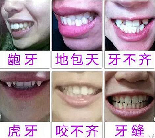 “發(fā)現即矯正”12歲前必須處理的20種兒童牙頜畸形 