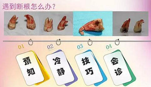 拔牙斷根的去與留？